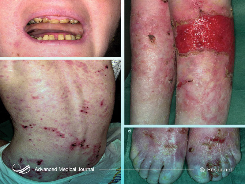 تاول‌های ناشی از بیماری ای بی هم روی پوست و هم در داخل بدن ایجاد می شوند.