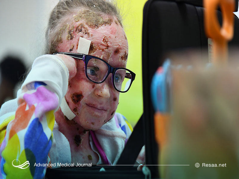 ناهنجاری‌های دندانی نیز از جمله ناهنجاری های بیماری پروانه ای می‌باشد.