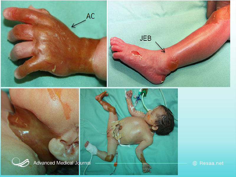 سندروم کیندلر سبب شکنندگی پوست می شود.