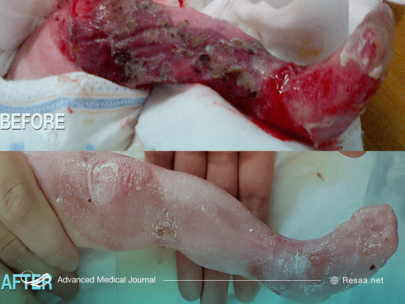 مراقبت های لازم در بیماری پروانه ای