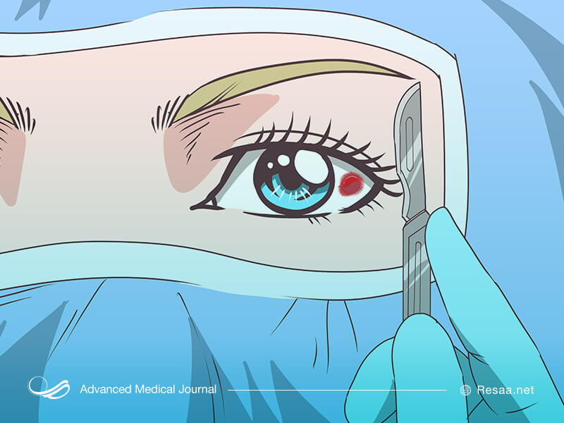 سرطان چشم از انواع بسیار نادر سرطان‌هاست و به ندرت اتفاق می‌افتد.