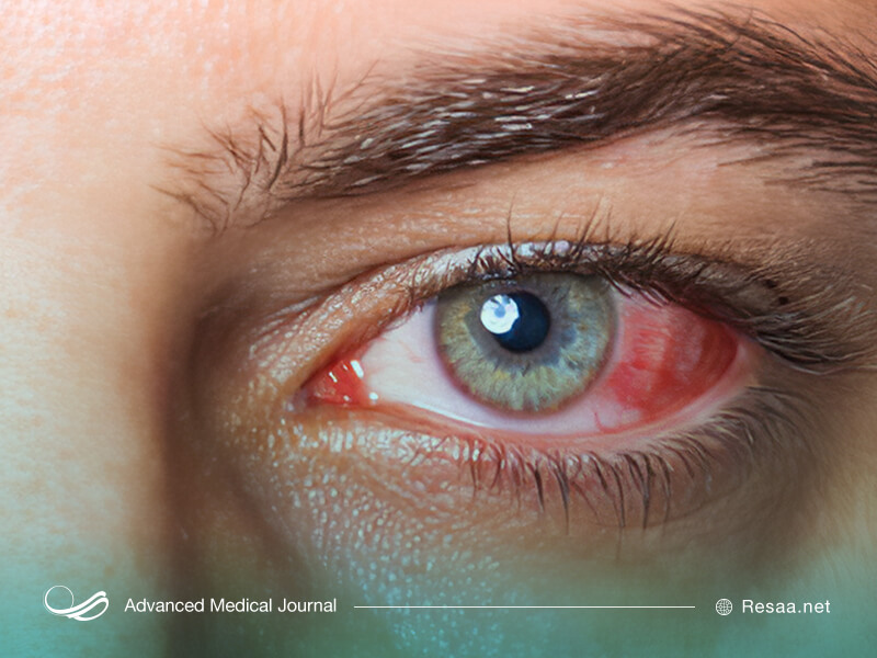 سرطان چشم انواع مختلفی دارد.