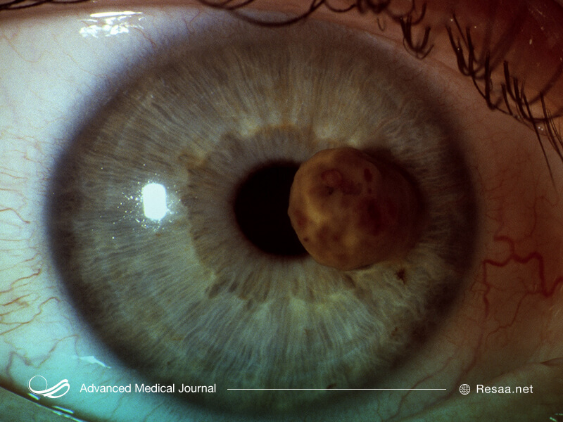 اگر توده ای در قرنیه چشم خود مشاهده کردید باید به پزشک برای معاینات بیشتر مراجعه نمایید.