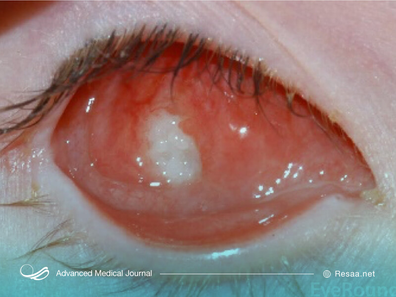 با تشخیص بیماری سرطان چشم، پزشکان راه‌های درمان را بررسی می‌کنند.