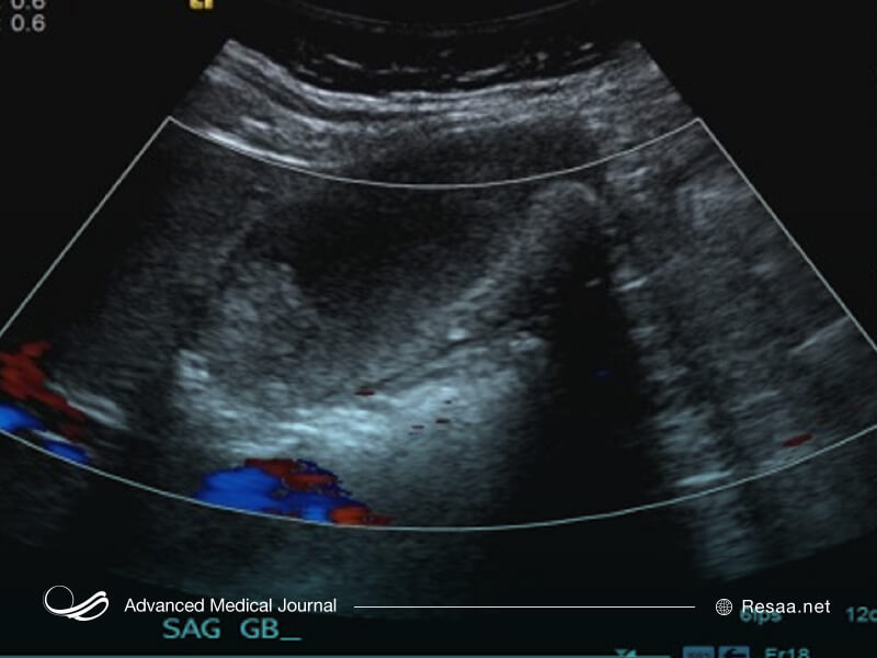 سونوگرافی روشی برای تشخیص سرطان کیسه صفرا