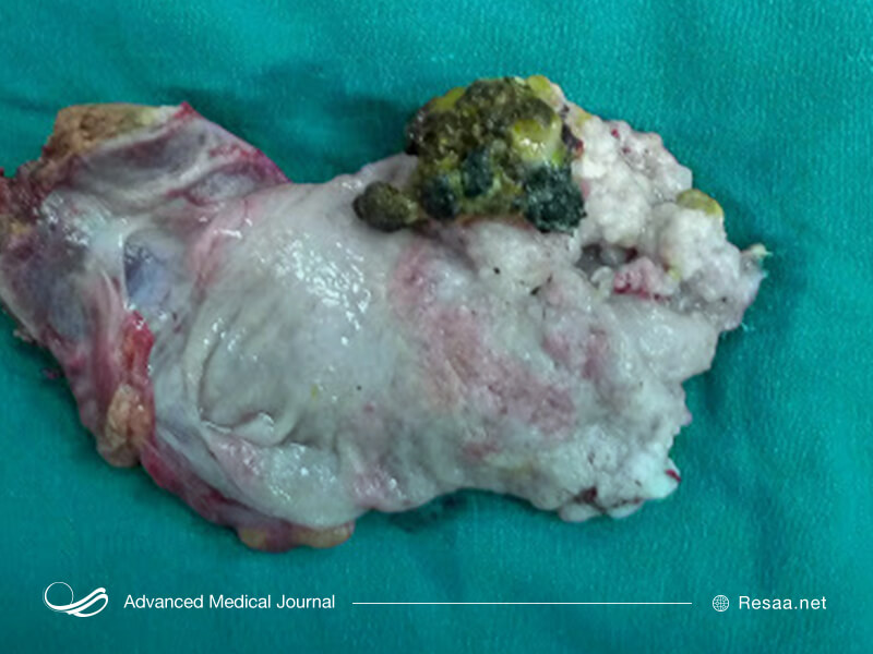 شکل تومور سرطانی کیسه صفرا