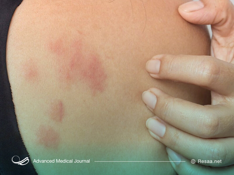 کهیر به صورت مقطعی در واکنش به برخی موارد آلرژیزا ایجاد میشود.