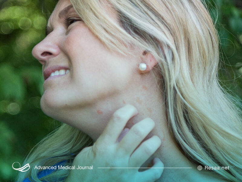 محل کهیر را نخارانید.