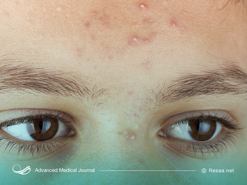 برای تشخیص علت کهیر ممکن است نیاز به آزمایشات پزشکی باشد.