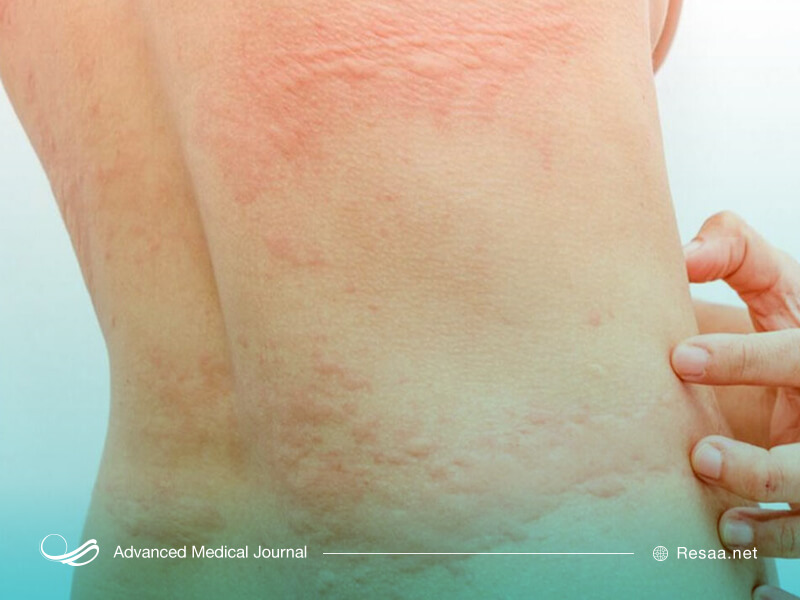 برای درمان کهیر داروهای مختلفی تجویز میشود.