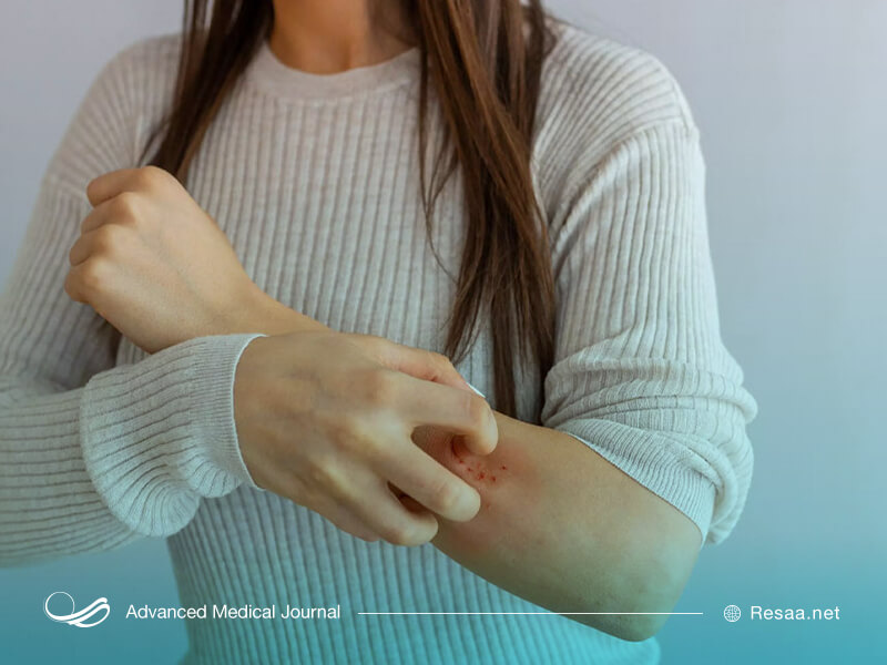 برای پیشگیری از کهیر از خوردن مواد حساسیتزا اجتناب ورزید.