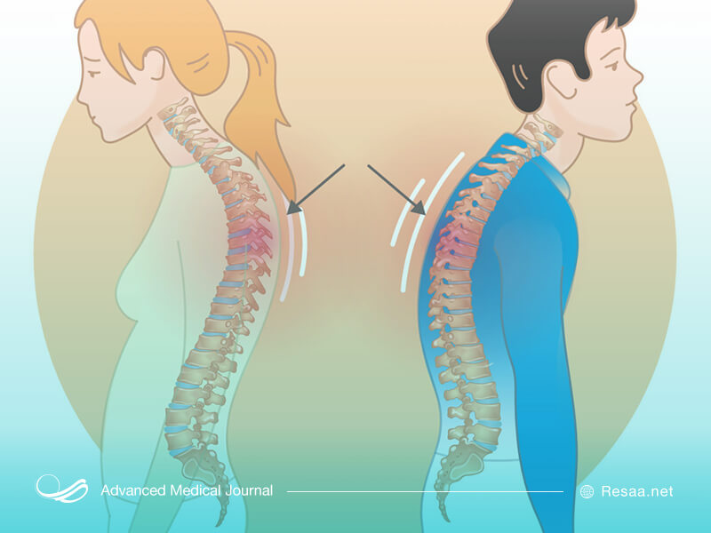 کیفوز نوعی حالت غیرعادی در گردن افراد است.
