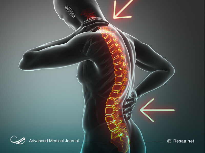 برای درمان کیفوز به یک متخصص ستون فقرات مراجعه کنید.