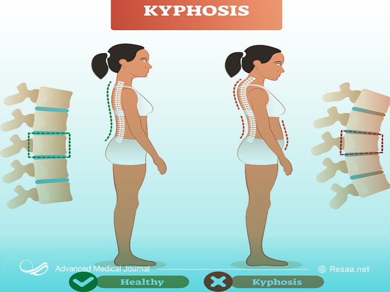 کیفوز با فشاز آوردن به ستون فقرات باعث کمردرد میشود.