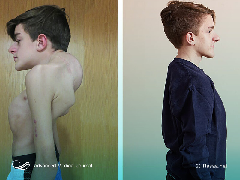 ناهنجاریهای کیفوزی به شکلهای متفاوتی ظاهر میشود.