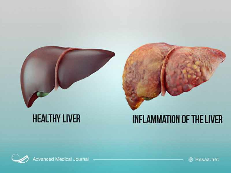 تصویر کبد سالم و کبد ملتهب که باهم مقایسه شدهاند.