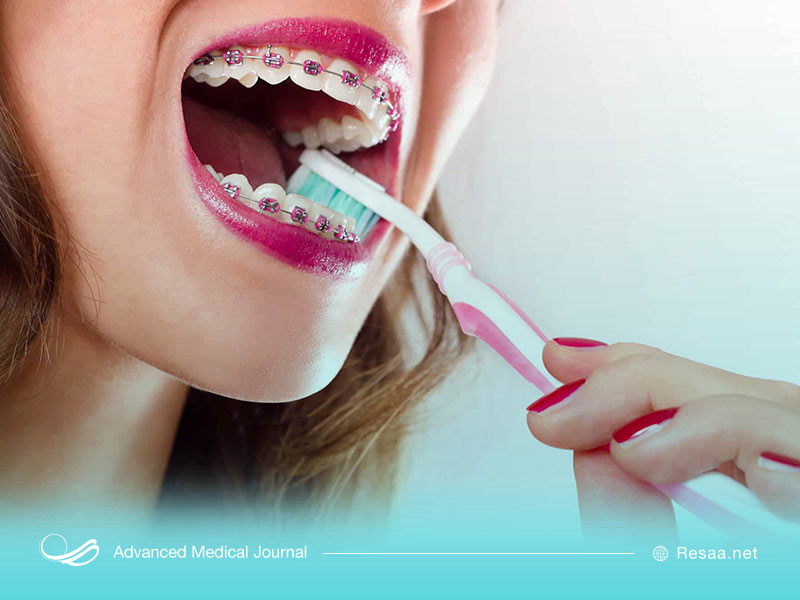 حفظ نظافت دندانها حین ارتودنسی