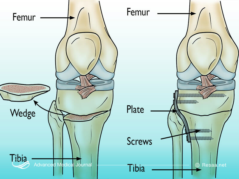 چرا به بیماری پاژه مبتلا میشویم