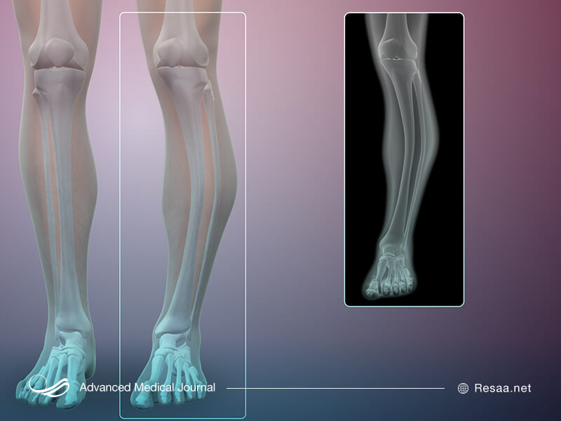 روش های تشخیص بیماری پاژه