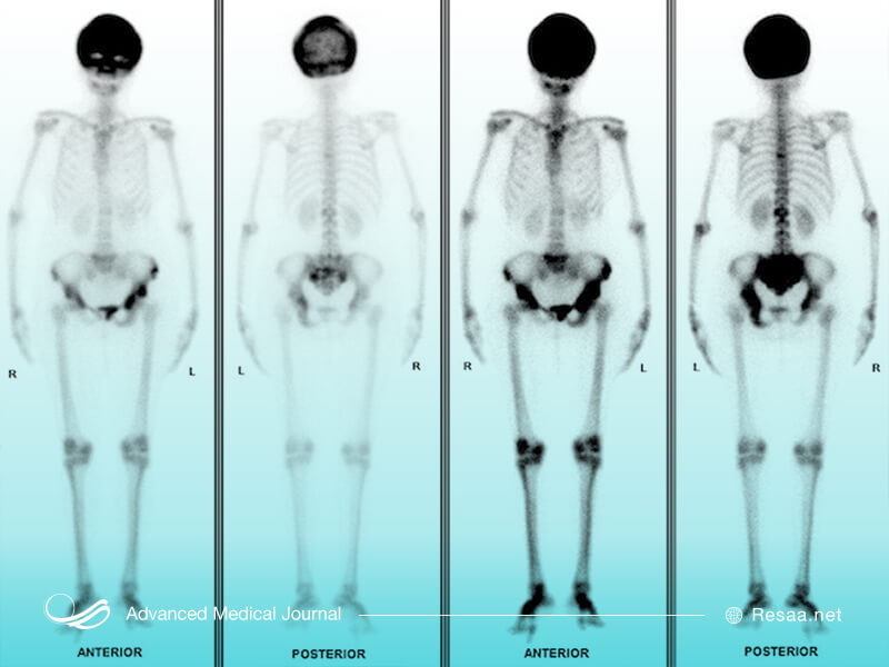 مقایسه اسکلت بدنی در فرد سالم و مبتلا
