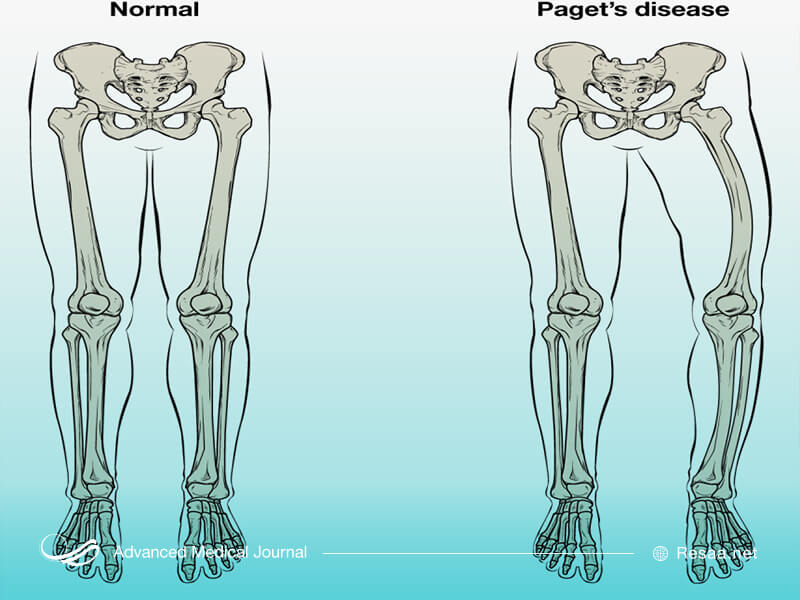 تاثیر بیماری پاژه بر استخوانها