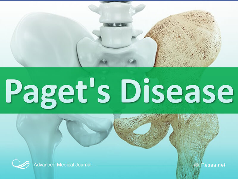 درمان بیماری پاژه