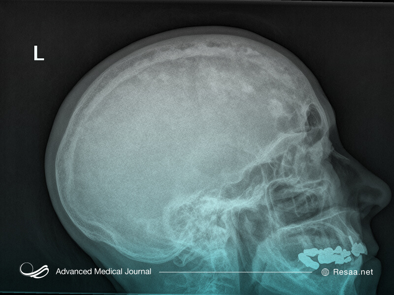 تصویر جمجمه،بیماری پاژه