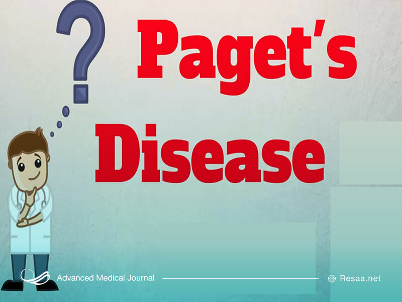 بیماری پاژه را بشناسیم