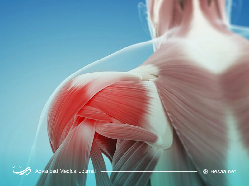 در رفتگی شانه