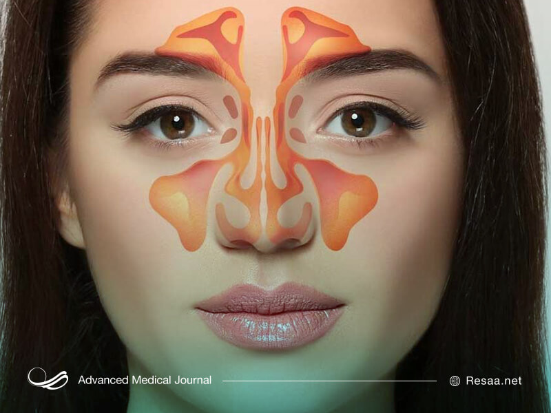 سینوزیت ممکن است در اثر آلرژی ایجاد شود.