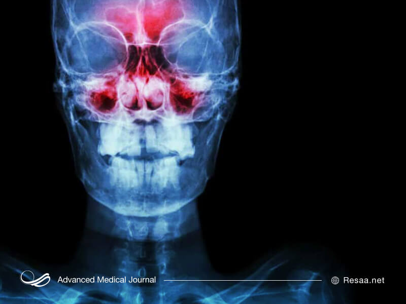تصویر ایکس ری سینوسها