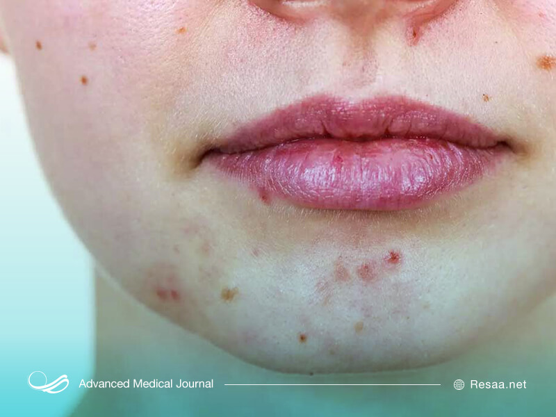 آکنه به شکل جوش‌های سرسیاه و سرسفید روی پوست ظاهر می‌شود.