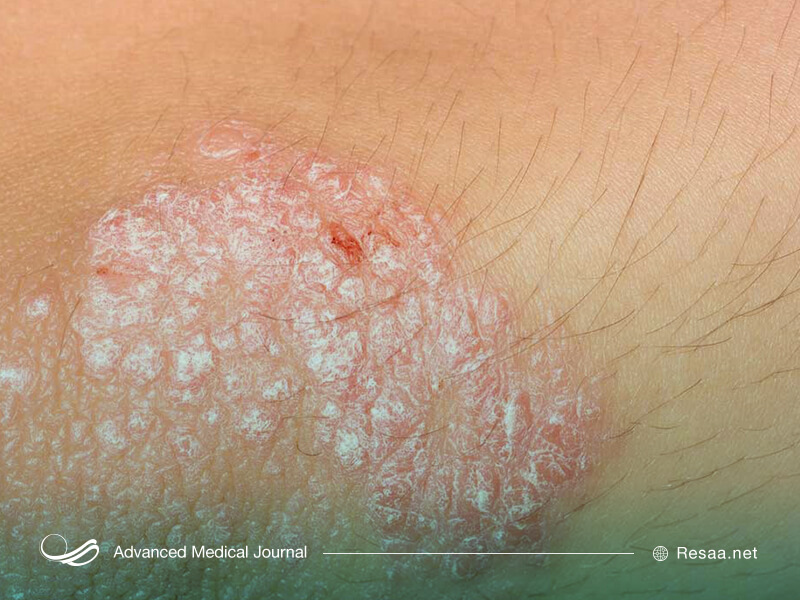 بیماری پوستی پسوریازیس نوعی بیماری خودایمنی می‌باشد.