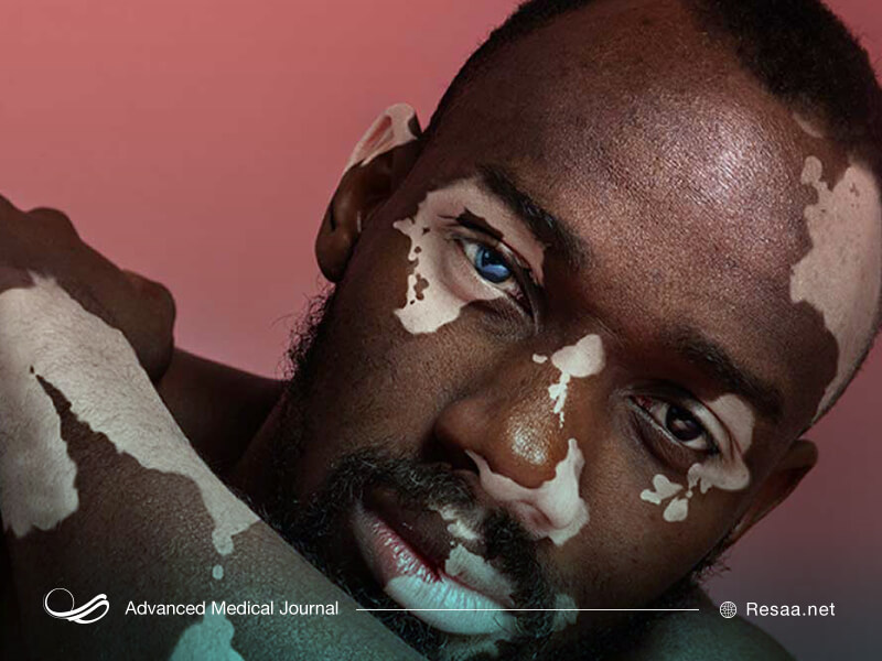 در بیماری پوستی لک و پیس رنگدانه‌های پوستی از بین می روند.