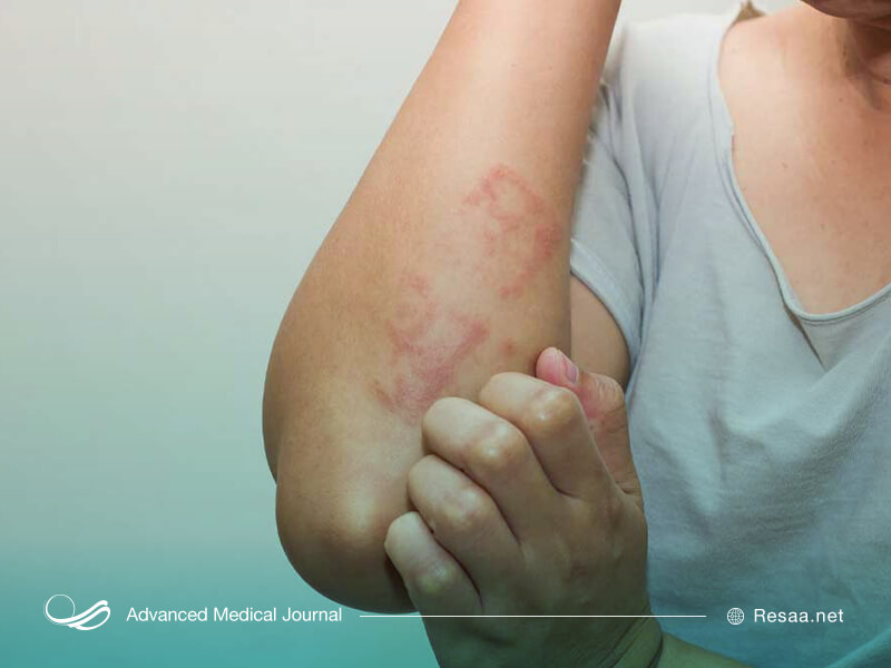 اگزما سبب التهاب و تحریک پوست می‌شود.