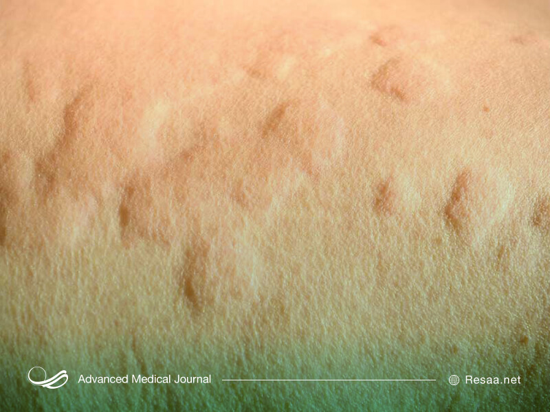 کهیر نوعی ضایعه پوستی که می‌تواند در اثر آلرژی به مواد غذایی یا سایر شرایط بوجود آید.