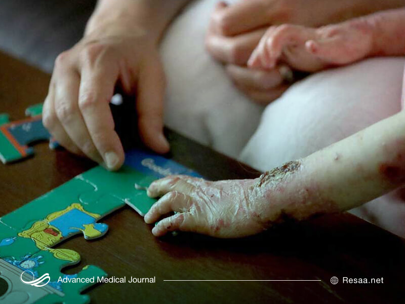 بیماری پروانه ای سبب ایجاد تاول روی پوست می‌شود.