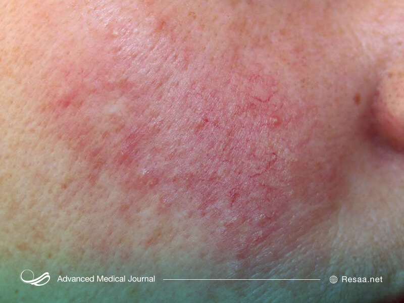 عازضه پوستی روزاسه سبب قرمر شدن پوست می‌شود.