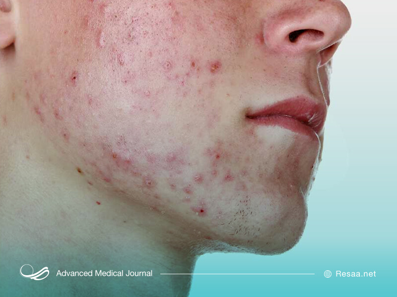 روزاسه درمان قطعی ندارد.