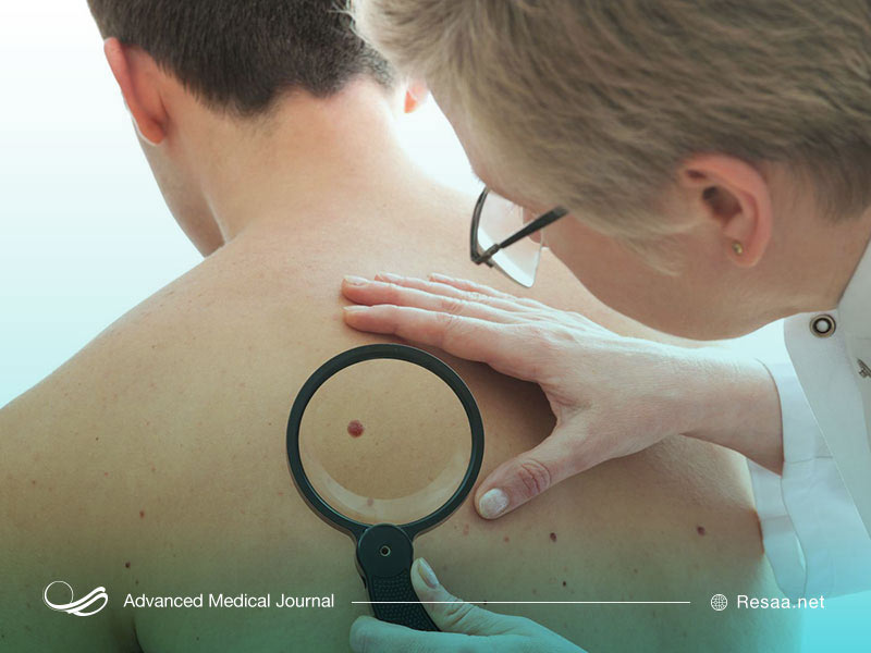 سرطان پوست چگونه شروع میشود