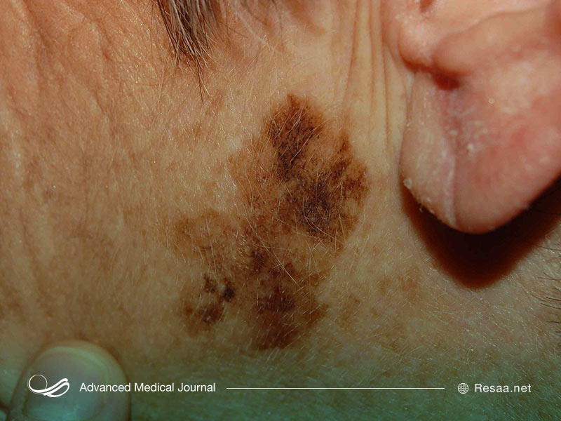 انواع سرطان پوست