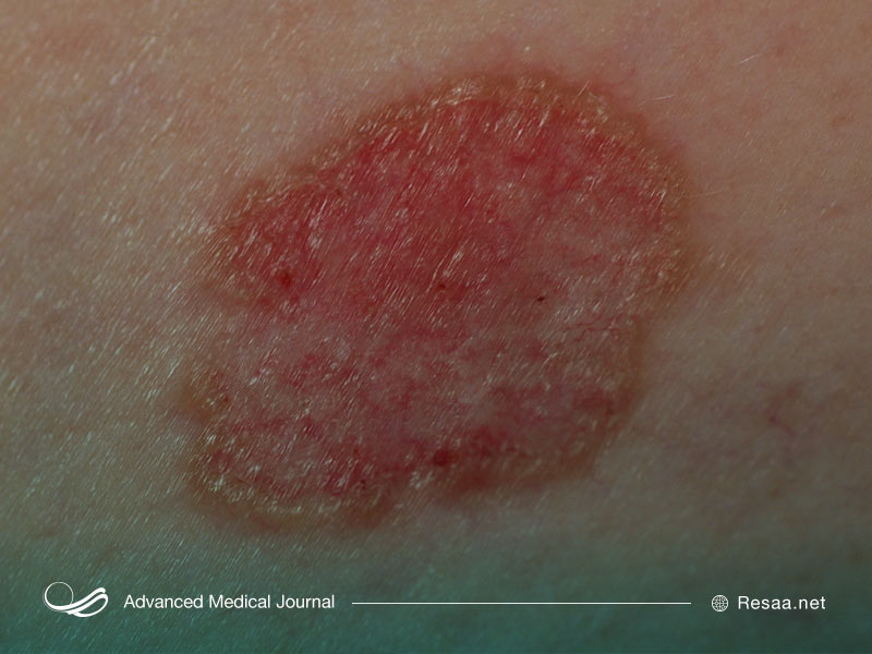 سرطان پوست و انواع آن