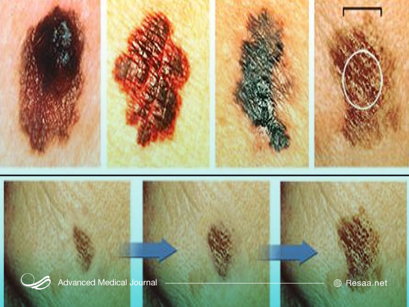 انواع لکه های پوستی دیگر