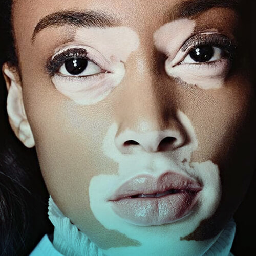 بیماری لک و پیس چیست؟ علائم و درمان لک و پیس