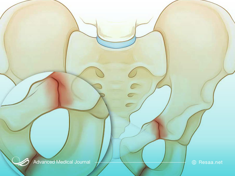 شکستگی لگن چیست
