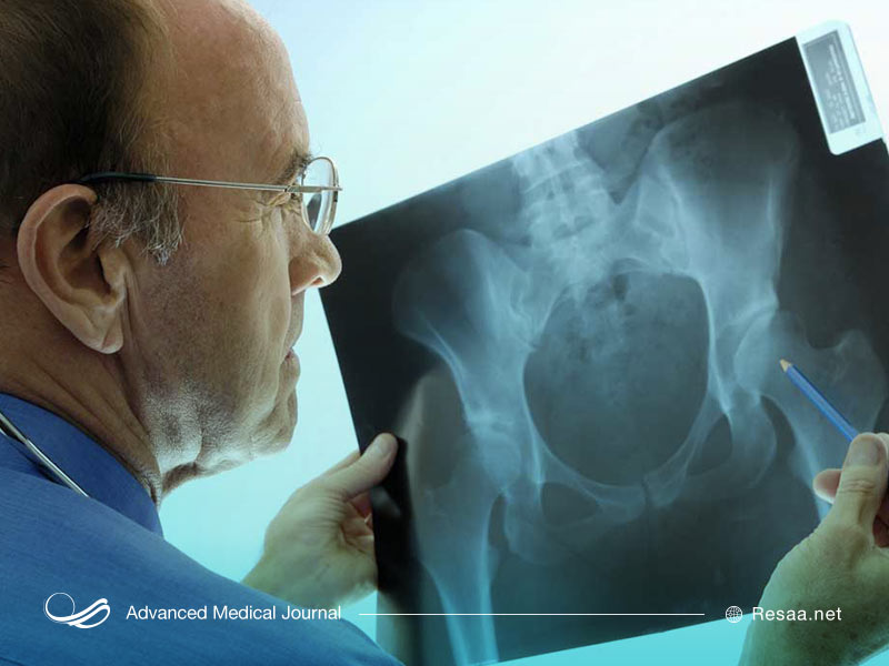 تشخیص شکستگی های لگن