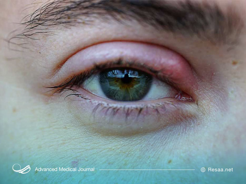 تصویری از گل مژه روی پلک بالایی