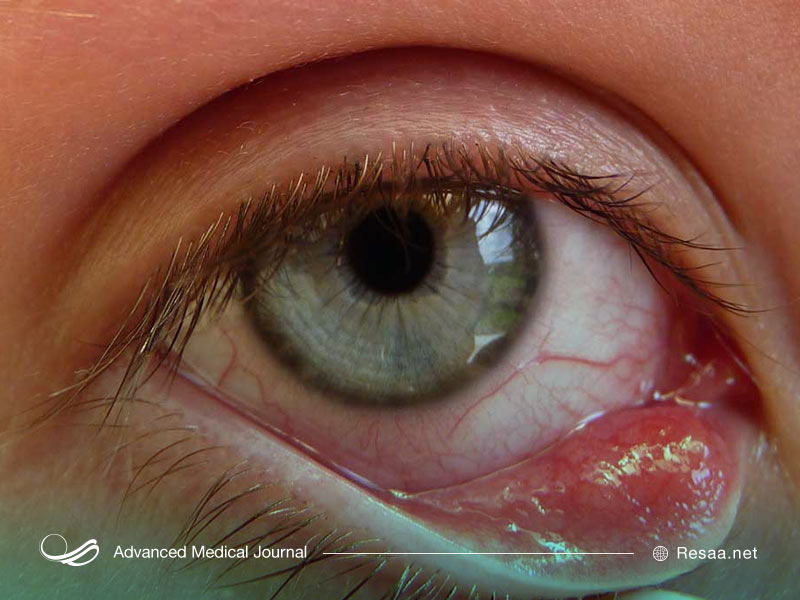 باقی ماندن ارایش چشم میتواند در بروز گل مژه موثر باشد.