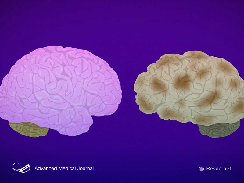 چه عواملی بروز آلزایمر را به تعویق میندازند