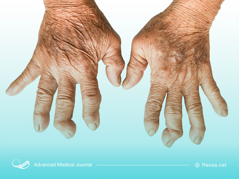 بیماری ارتریت روماتوئید و اثر آن روی دست